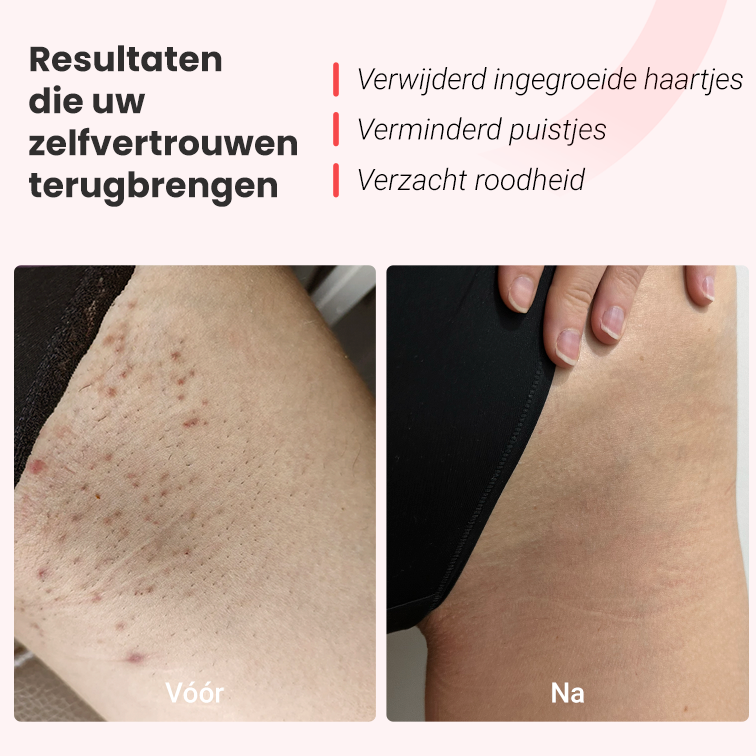 IPL fotoepilator Hilda