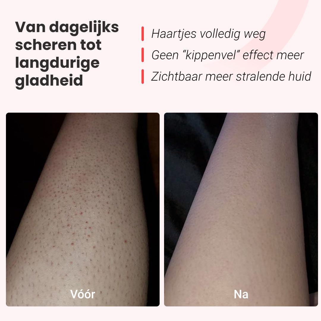 IPL fotoepilator Hilda